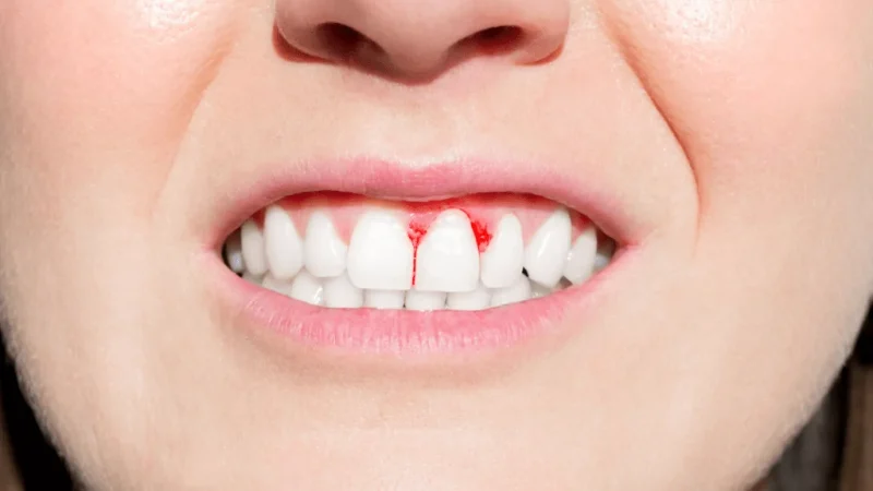 Diş Eti Hastalıkları Tedavileri