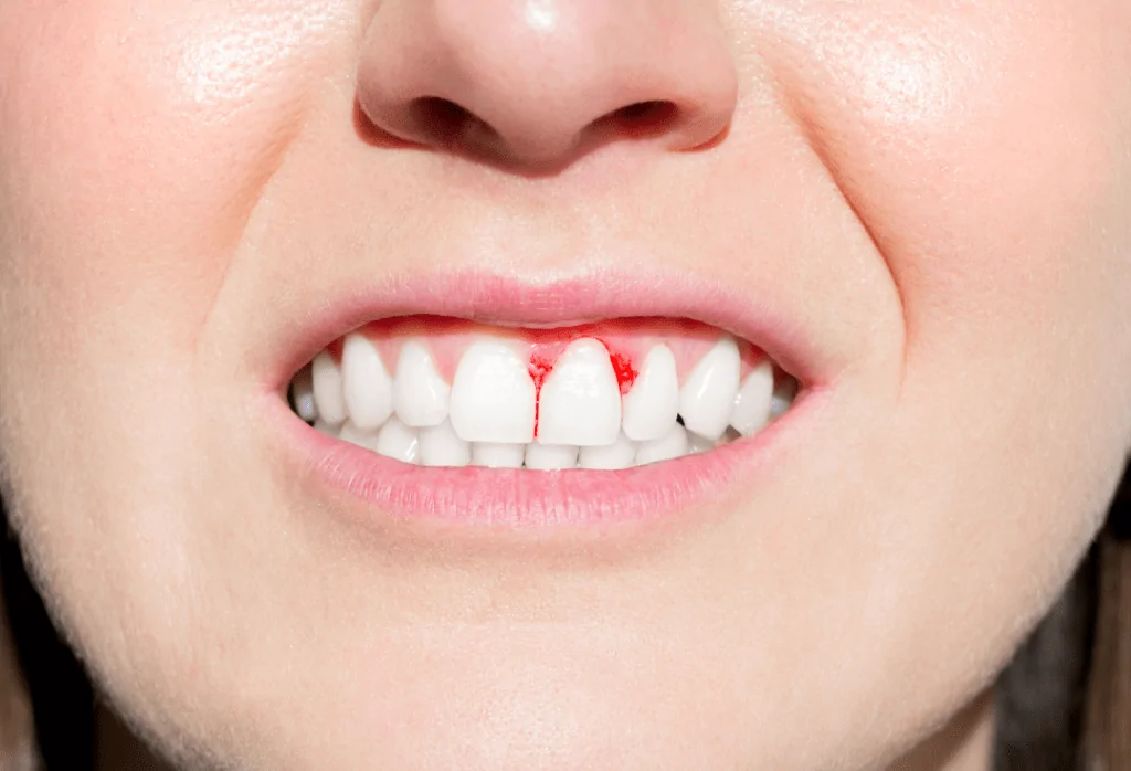 Diş Eti Hastalıkları Tedavileri