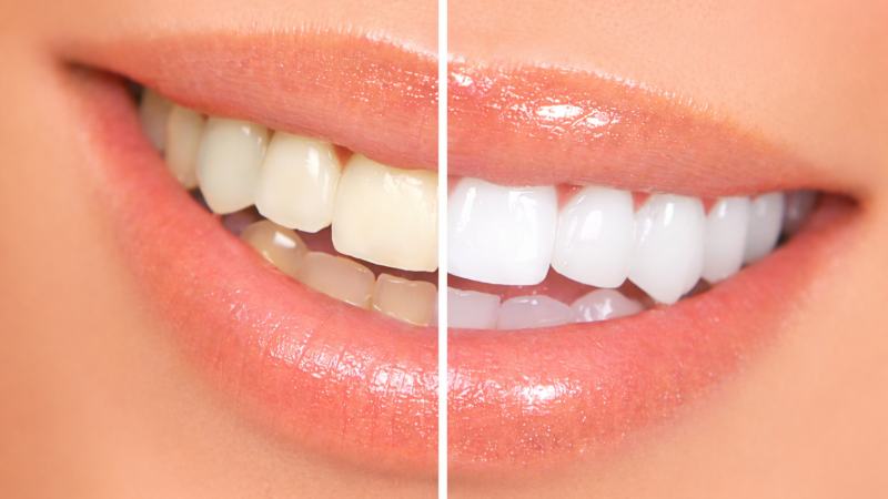 Bleaching (Diş Beyazlatma)